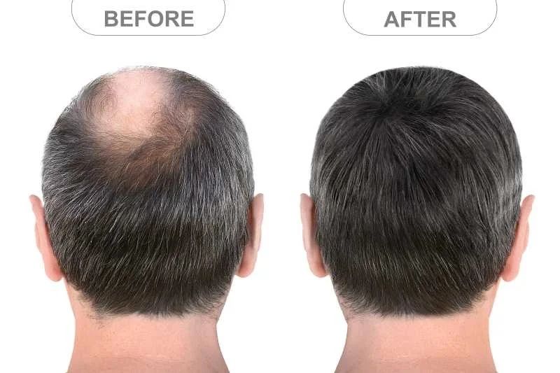 Non-Surgical Hair Volumizing Explained: Overview, Basics, Insights & Practical Tips